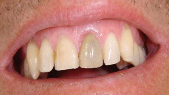 Chữa tủy răng cửa như thế nào? Có đau không? – Thông tin cần biết