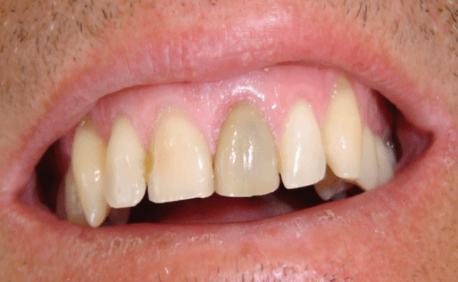 Quá trình chữa tủy răng cửa như thế nào?