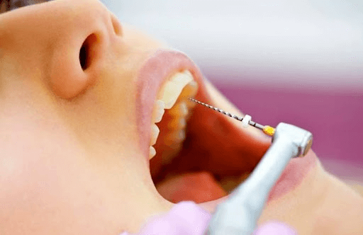 Chữa tủy răng cửa có đau không?