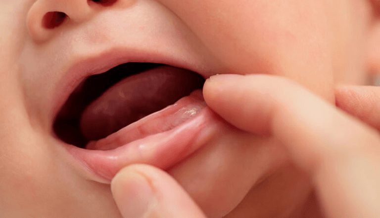 Hướng dẫn cách điều trị nhiệt miệng ở nhà cho trẻ