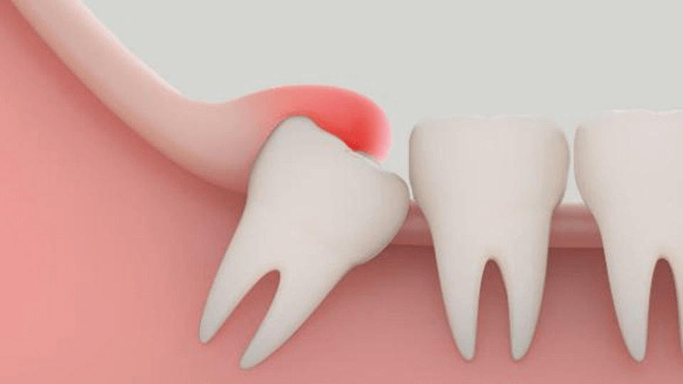 Tìm hiểu viêm lợi trùm răng khôn là gì?