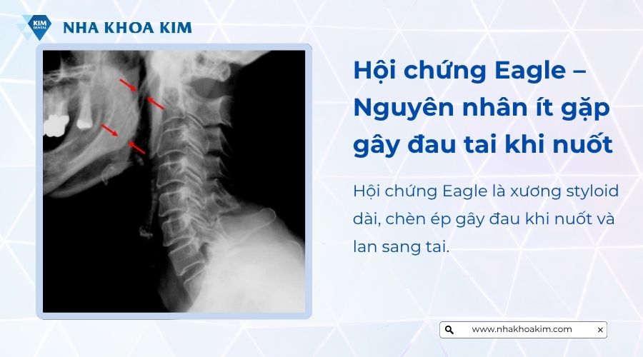 Hội chứng Eagle nguyên nhân ít gặp gây đau tai nuốt nước bọ