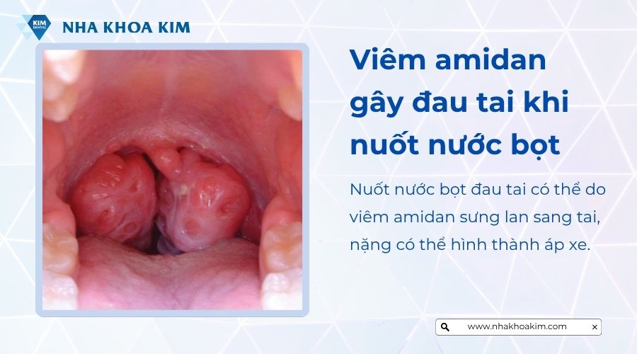 Viêm amidan một trong những nguyên nhân gây nướt nước bọt đau họng