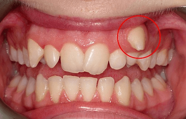 Răng khểnh mọc như thế nào? Tất tần tật thông tin về răng khểnh