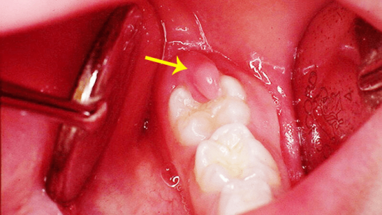 Những thông tin bạn cần biết về viêm lợi răng hàm