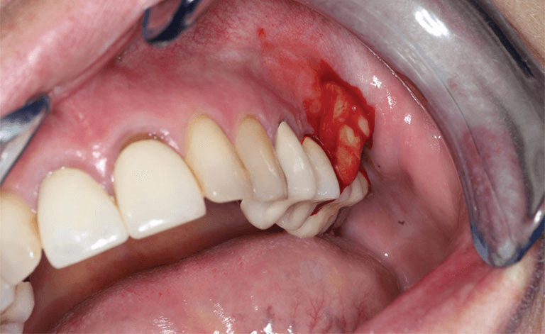 Viêm lợi răng hàm do nguyên nhân gì?