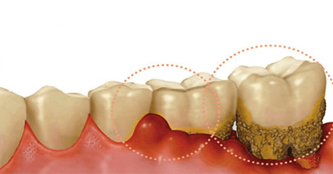 Viêm lợi răng hàm có những biểu hiện nào?