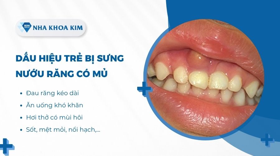 Dấu hiệu trẻ bị sưng nướu răng có mủ