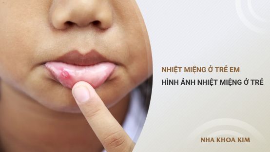 Nhiệt miệng ở trẻ em và một số hình ảnh nhiệt miệng ở trẻ