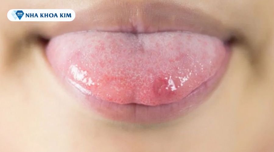 hình ảnh nhiệt miệng ở trẻ trên lưỡi