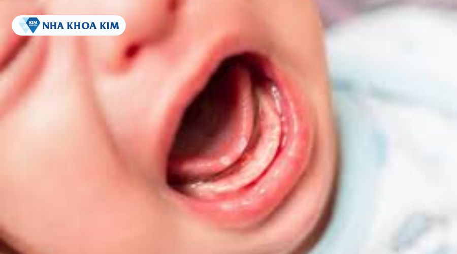 Nốt nhiệt lưỡi ở trẻ sơ sinh