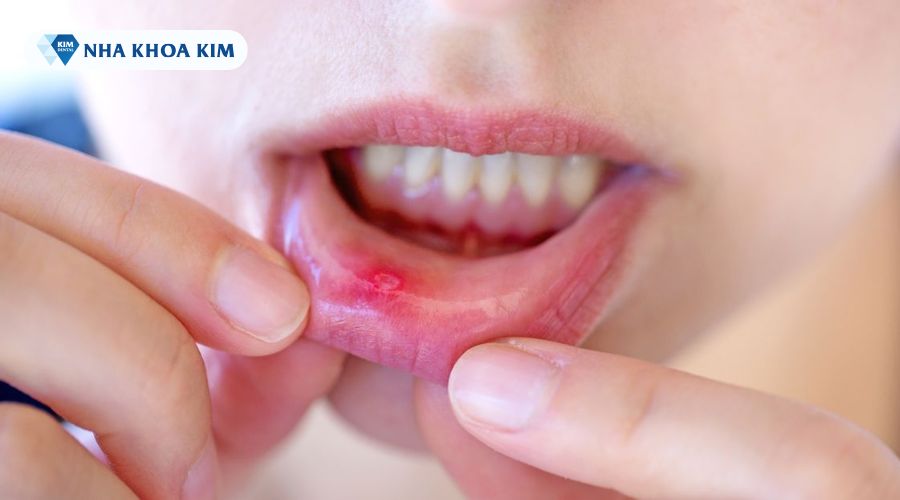 Hình ảnh vết loét miệng ở trẻ
