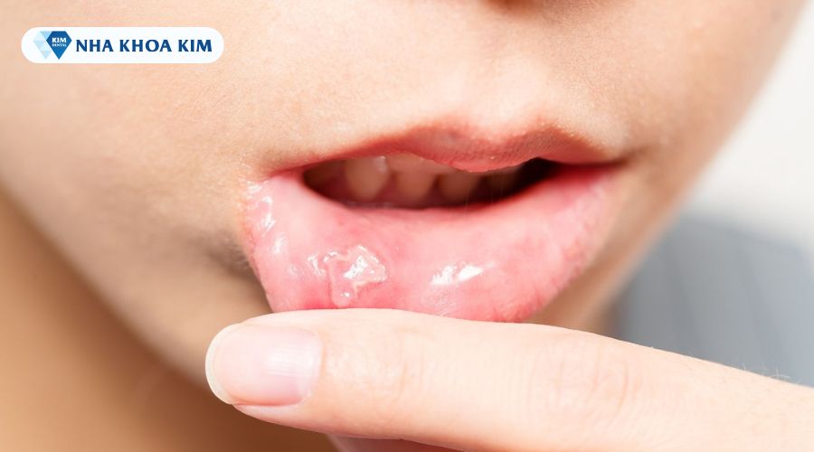 Bệnh nhiệt miệng ở trẻ em