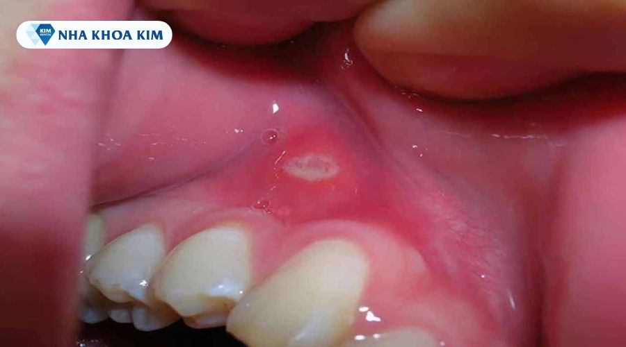Hình ảnh nhiệt miệng ở nướu