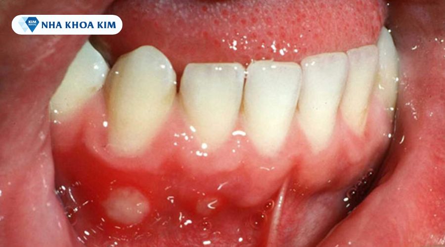 Nổi nhiệt miệng trên nướu