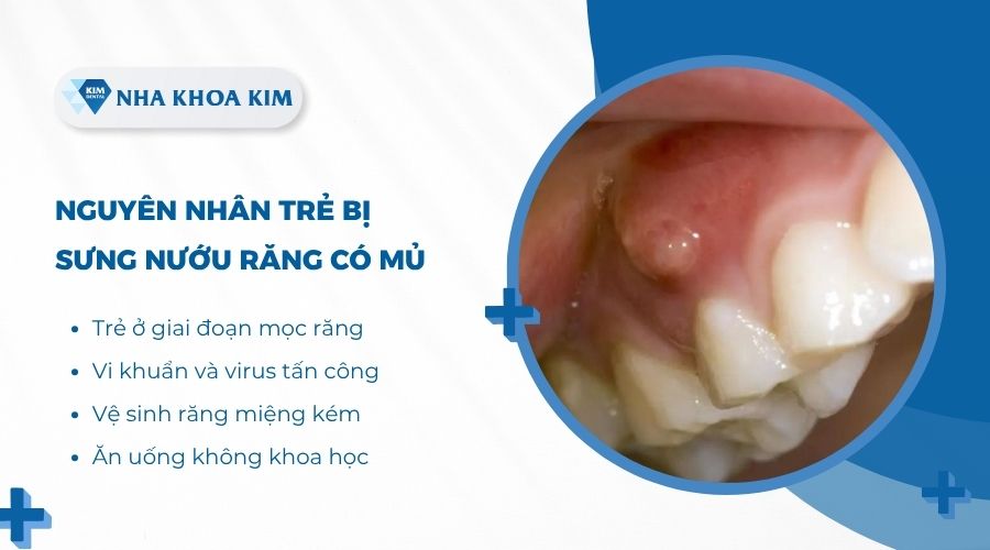 Nguyên nhân trẻ bị sưng nướu răng có mủ