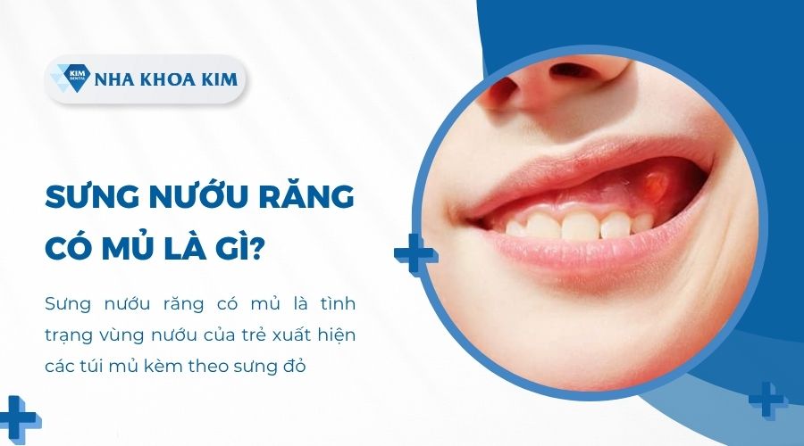 Sưng nướu răng có mủ là gì?