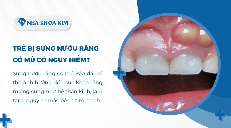 Trẻ bị sưng nướu răng có mủ có nguy hiểm không?