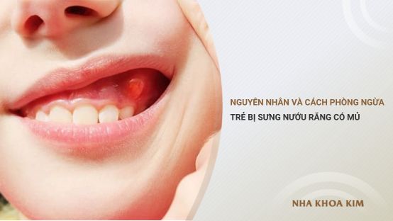 Nguyên nhân và cách phòng ngừa trẻ bị sưng nướu răng có mủ