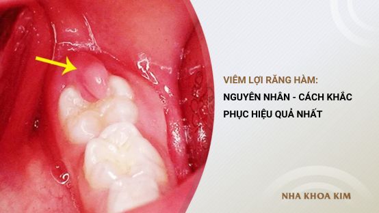 Những thông tin bạn cần biết về viêm lợi răng hàm