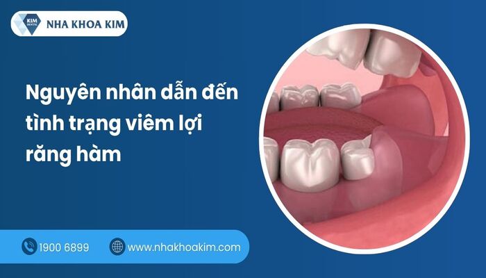 nguyên nhân bị viêm lợi răng phía trong
