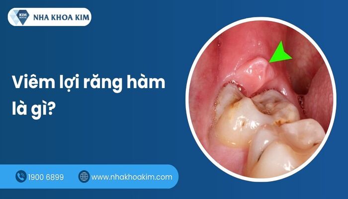 viêm lợi răng hàm là gì