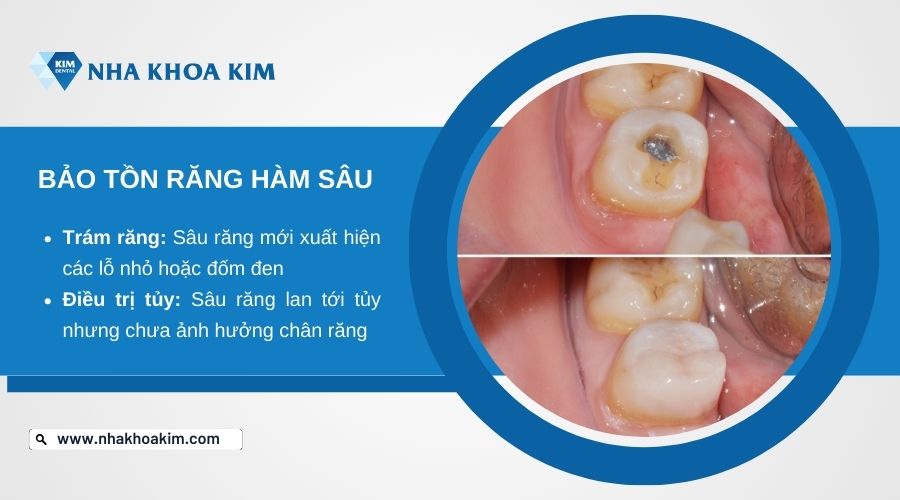 phương pháp bảo tồn răng 