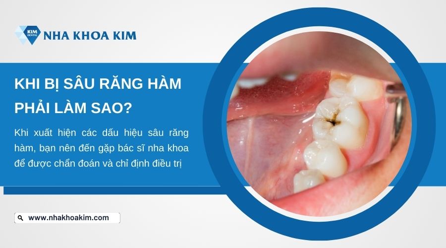 bị sâu răng hàm phải làm sao