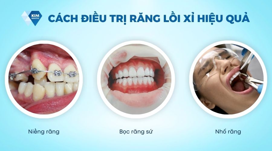 cách khắc phục răng bị lồi xỉ