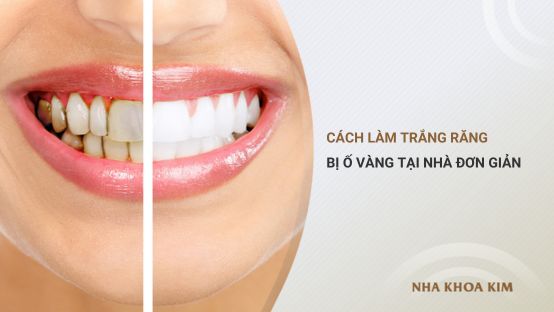 Cách làm trắng răng bị ố vàng tại nhà đơn giản và nhanh chóng