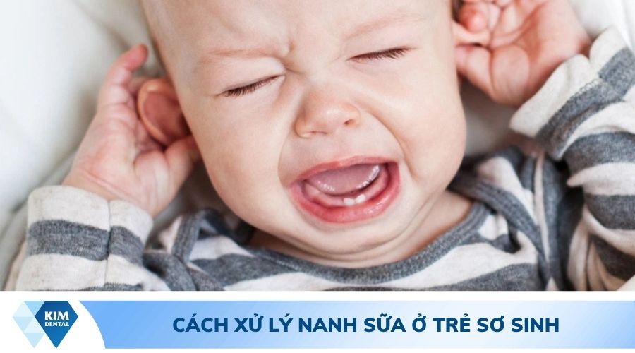 cách xử lý nanh sữa ở trẻ sơ sinh