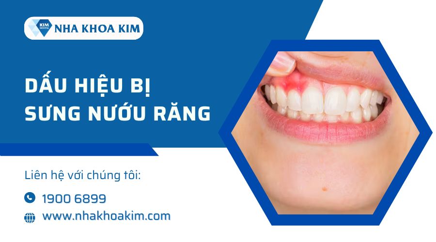 Dấu hiệu bị sưng nướu răng