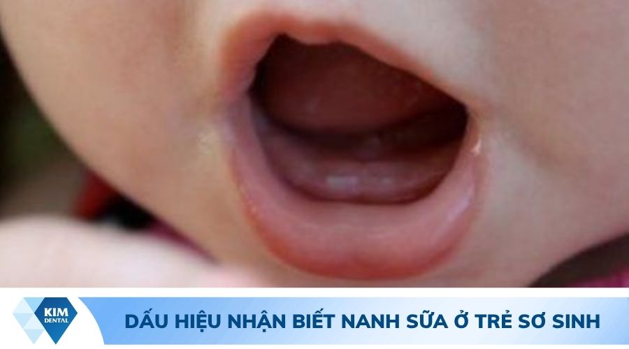 dấu hiệu nhận biết nanh sữa ở trẻ sơ sinh