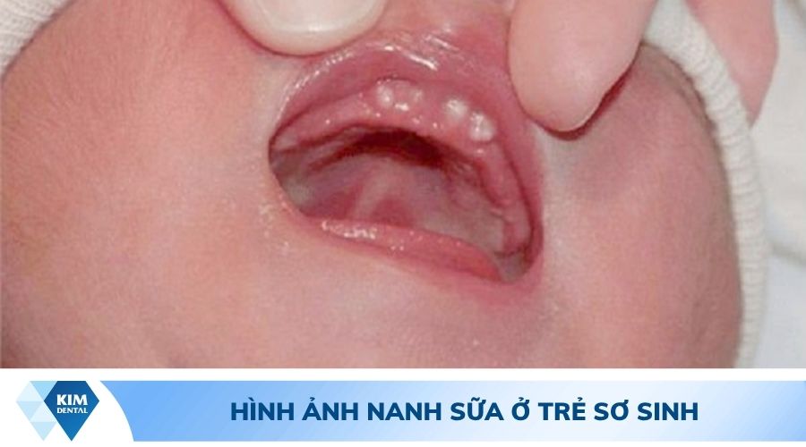 Hình ảnh nanh sữa ở trẻ sơ sinh 01