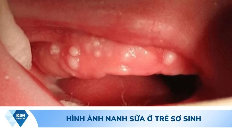Hình ảnh trẻ sơ sinh mọc nanh sữa