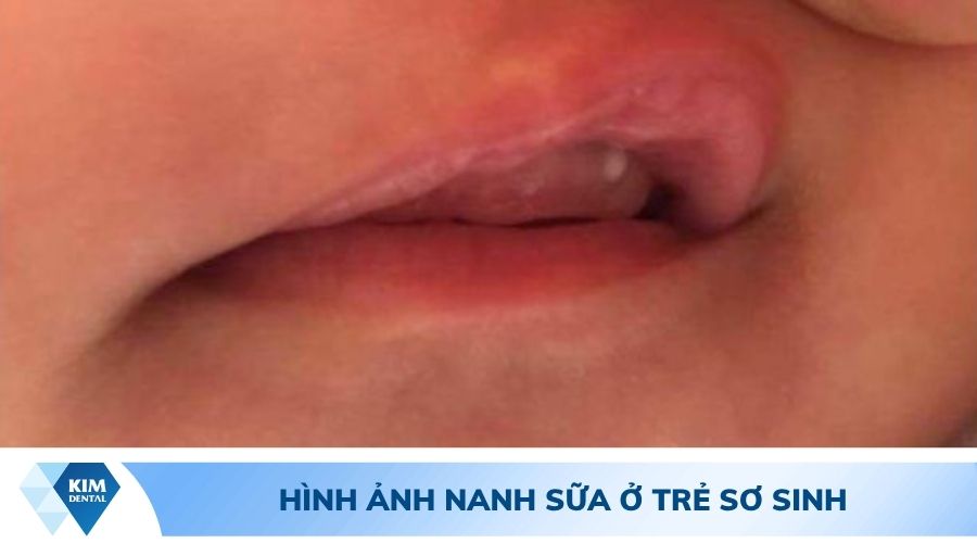 Hình ảnh trẻ bị nanh sữa 03