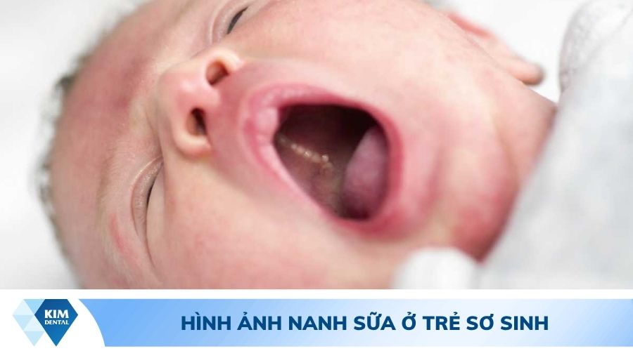 Hình ảnh nướu răng có đốm trăng ở trẻ sơ sinh