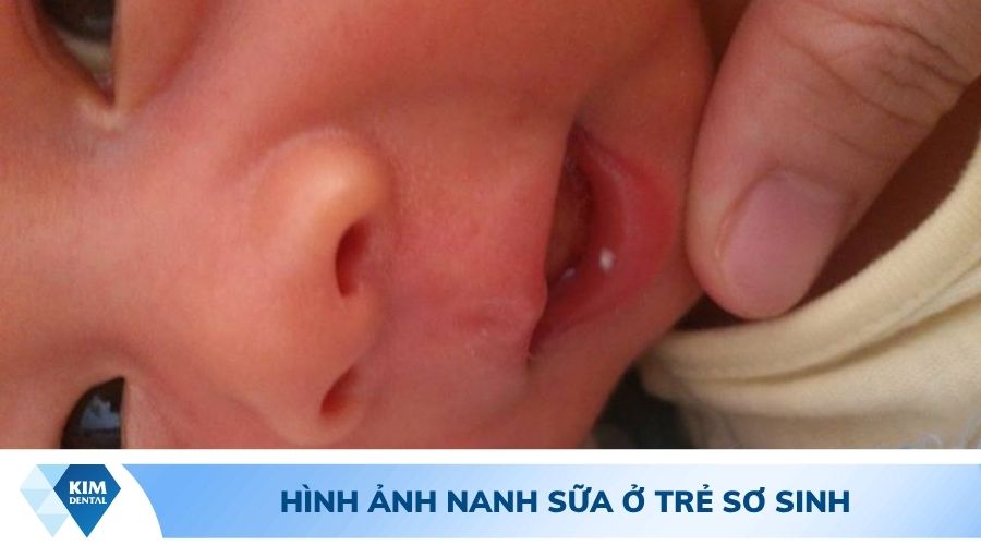 Hình ảnh trẻ bị nanh sữa phải làm sao