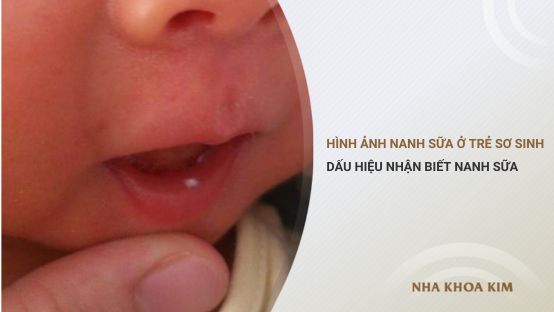 Hình ảnh nanh sữa ở trẻ sơ sinh và cách chữa trị nanh sữa