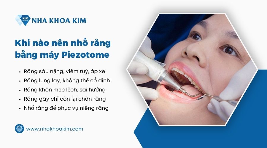 khi nào nên nhổ răng bằng máy siêu âm piezotome