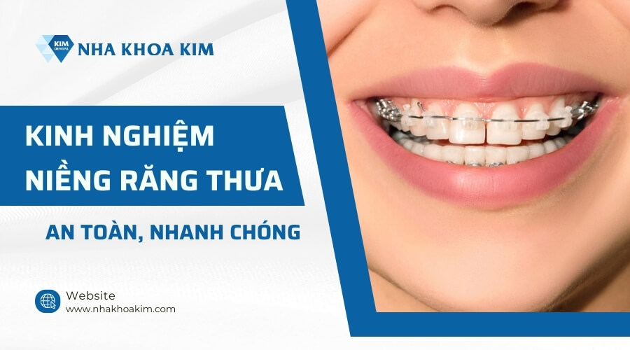 Kinh nghiệm niềng răng thưa 