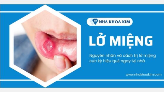 Lở miệng (Viêm loét miệng): Nguyên nhân và cách điều trị