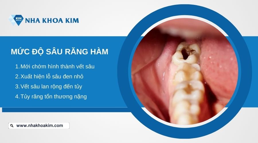 các mức độ sâu răng hàm