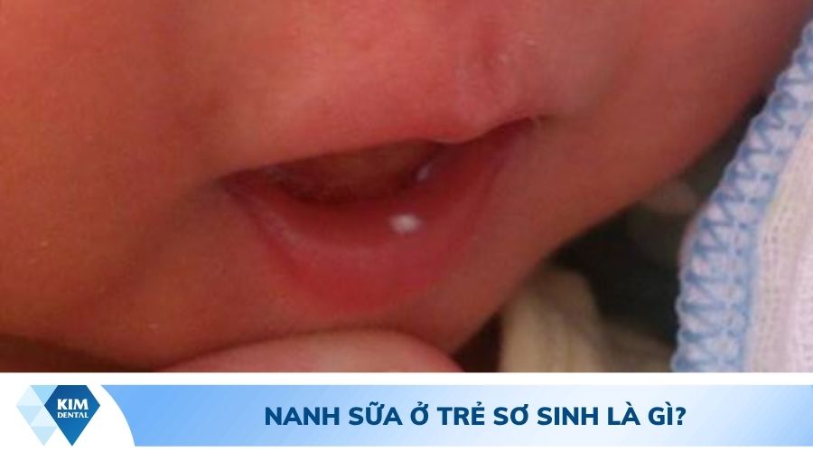 nanh sữa ở trẻ sơ sinh là gì