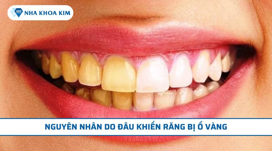 nguyên nhân khiến răng bị ố vàng