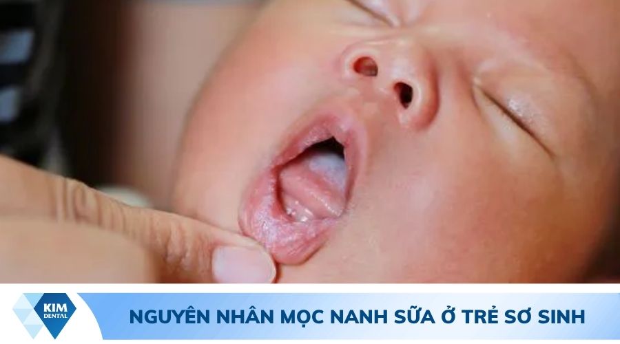 Nguyên nhân mọc nanh sữa ở trẻ sơ sinh