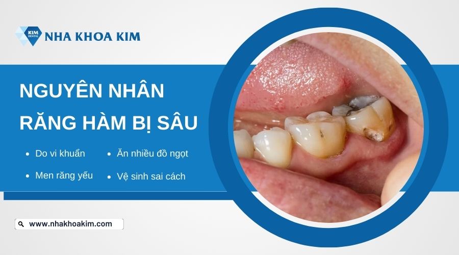 nguyên nhân khiến răng hàm bị sâu