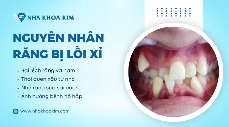 nguyên nhân răng bị lồi xỉ
