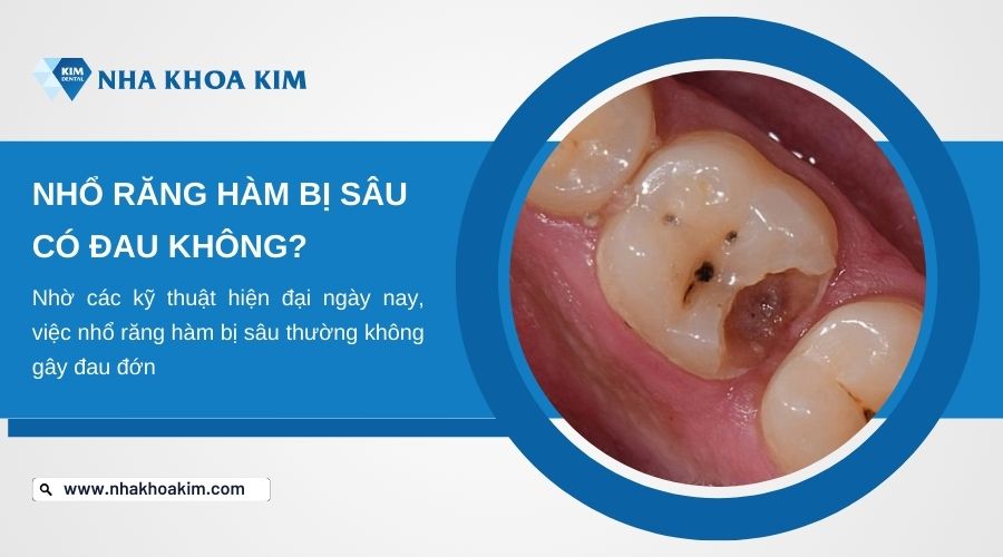 nhổ răng hàm bị sâu có đau không