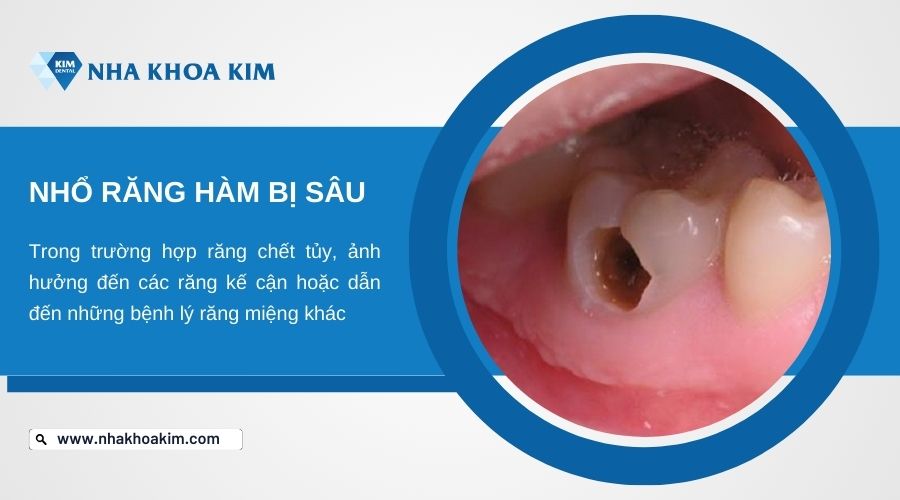 nhổ răng hàm bị sâu